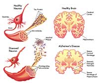 Alzheimers by OC Neurological Institute 2 - Alzheimer’s
