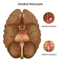 Aneurysms by OC Neurological Institute - Aneurysms