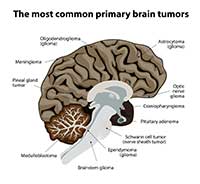 Brain Tumors by OC Neurological Institute 2 - Brain Tumors