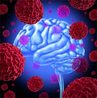 Brain Tumors by OC Neurological Institute - Brain Tumors