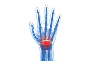 Carpal Tunnel Syndrome by OC Neurological Institute 2 300x200 - Carpal Tunnel Syndrome