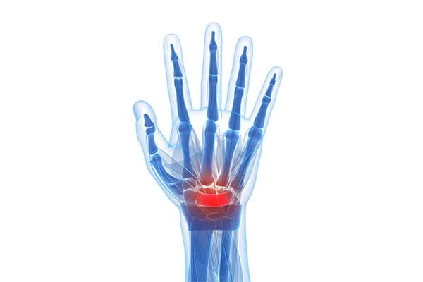 Carpal Tunnel Syndrome by OC Neurological Institute 2 - Conditions
