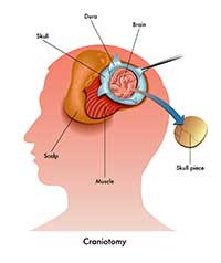 Craniotomy by OC Neurological Institute 1 - Craniotomy