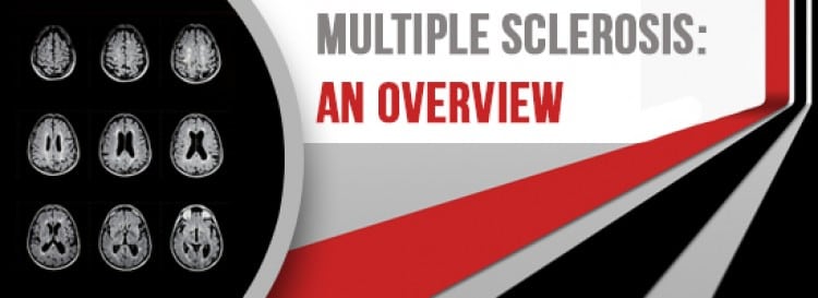 Multiple Sclerosis An Overview by Orange County Neurosurgical Institute - Multiple Sclerosis: An Overview