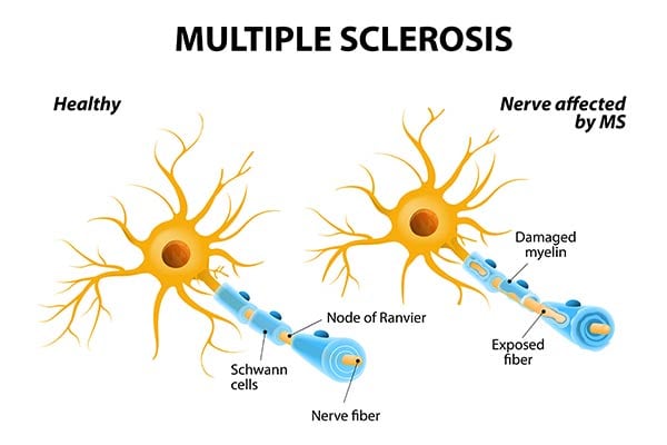 Multiple Sclerosis by OC Neurological Institute 1 - Conditions