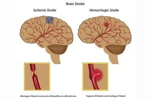 Stroke by OC Neurological Institute 2 300x200 - Stroke