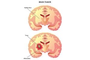Tumor Removal by OC Neurological Institute 1 300x200 - Tumor Removal