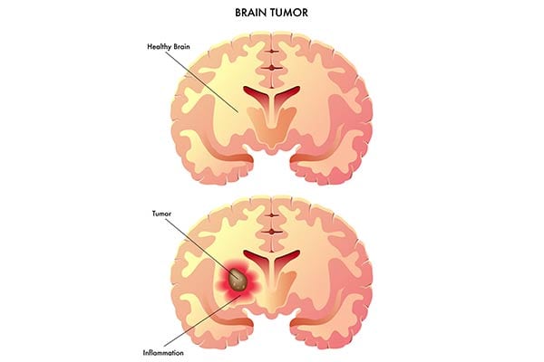 Tumor Removal by OC Neurological Institute 1 - Treatments