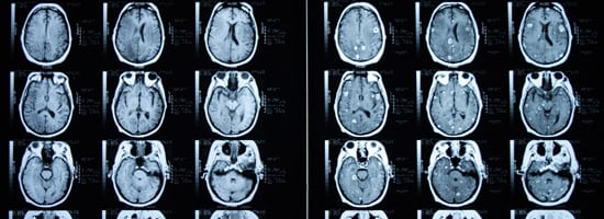 When to Take Action for Brain Vascular Lesions Orange County Neurosurgical Institute - When to Take Action for Brain Vascular Lesions